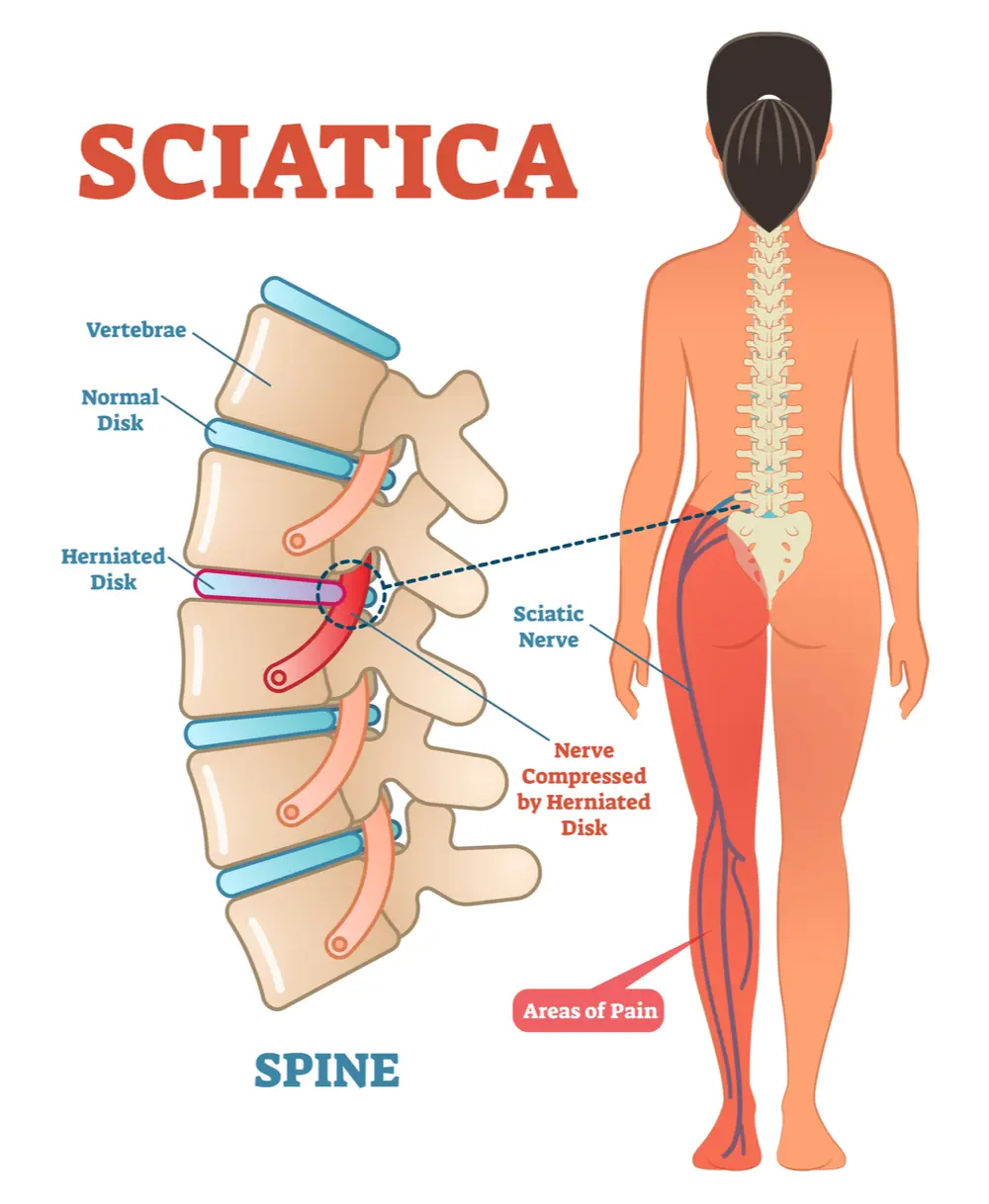 Sciatica, shooting leg pain  Cincinnati, OH Mayfield Brain & Spine