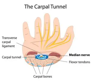 Carpal Tunnel Treatment Brisbane CBD