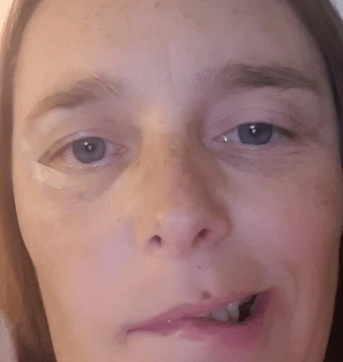 Bell S Palsy Brisbane Laser Is A Game Changer For Bell S Palsy Treatment