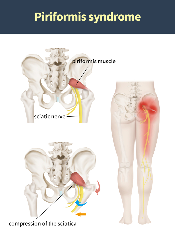 What Is The Treatment For Sciatica